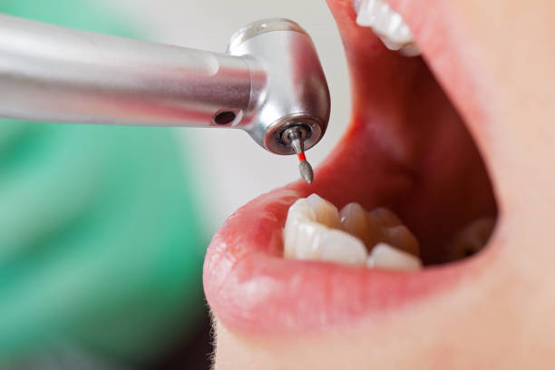 Best Emergency Treatment for Dental Infections or Abscesses in Central Garage, VA
